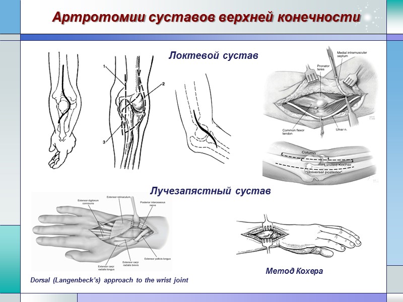 Артротомии суставов верхней конечности Dorsal (Langenbeck’s) approach to the wrist joint Метод Кохера Локтевой